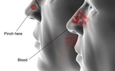 Panik Saat Epistaksis Menyerang, Berikut Cara Mengatasinya 