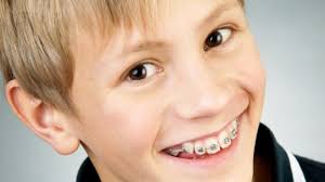 Dampak Bahaya Behel GIGI Yang Di anggap Keren Oleh Para Remaja.!