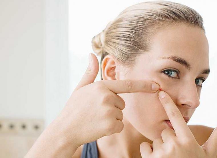 APA ITU ACNE VULGARIS?? | Blog - Eventkampus.com