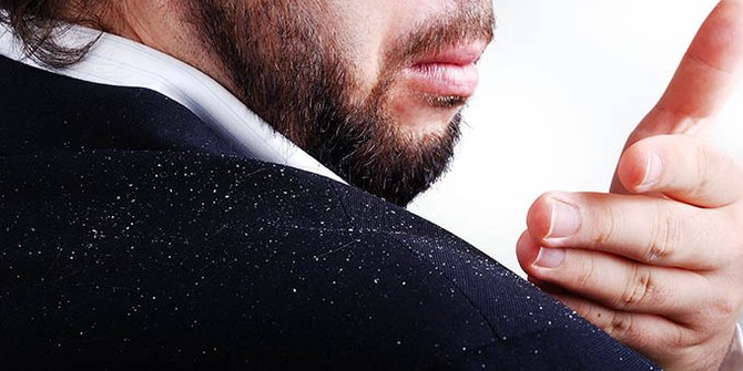 Ini Dia ! Cara Menghilangkan Ketombe di Rambut!