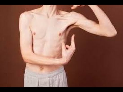 Penyebab Susah Gemuk