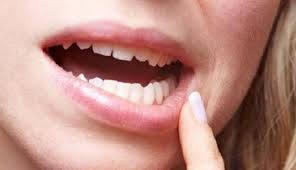 Bahan Alami Untuk Mengobati Gusi Bengkak