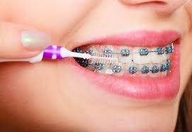 8 Manfaat Menggunakan Kawat Gigi (Behel)