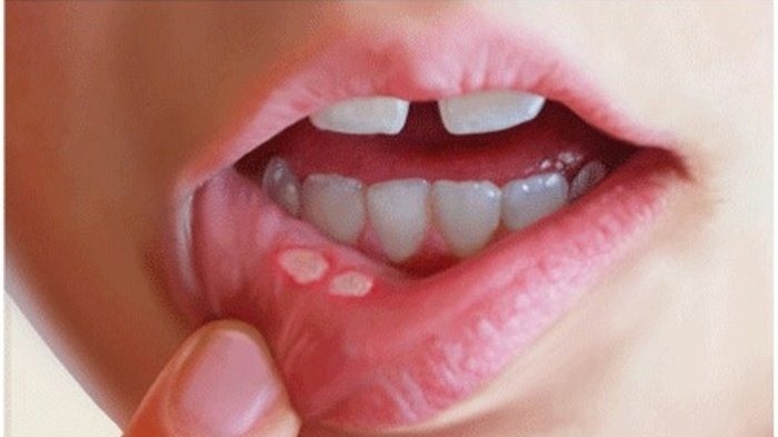 Cara Jitu Mengatasi Sariawan