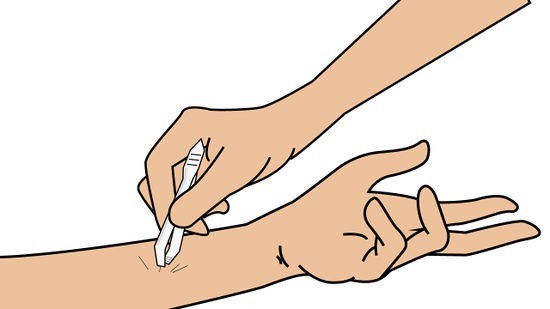 Cara Mengeluarkan Duri atau Serpihan Kayu dari Balik Kulit Kita