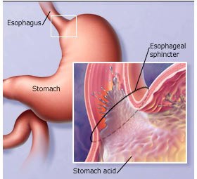 PENYEBAB DAN PANTANGAN BAGI  PENDERITA MAAG
