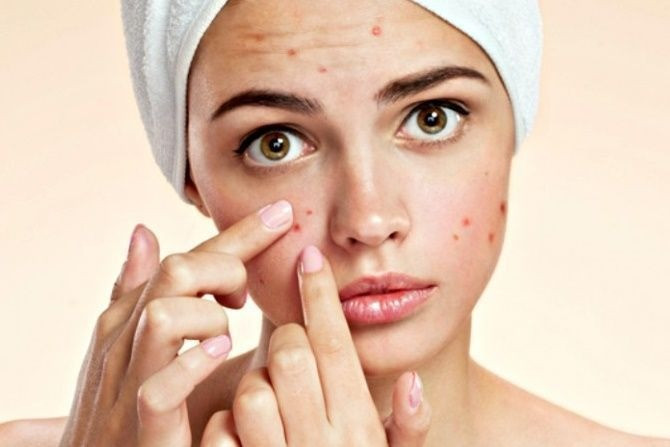 Tips Merawat Kulit dari Jerawat!